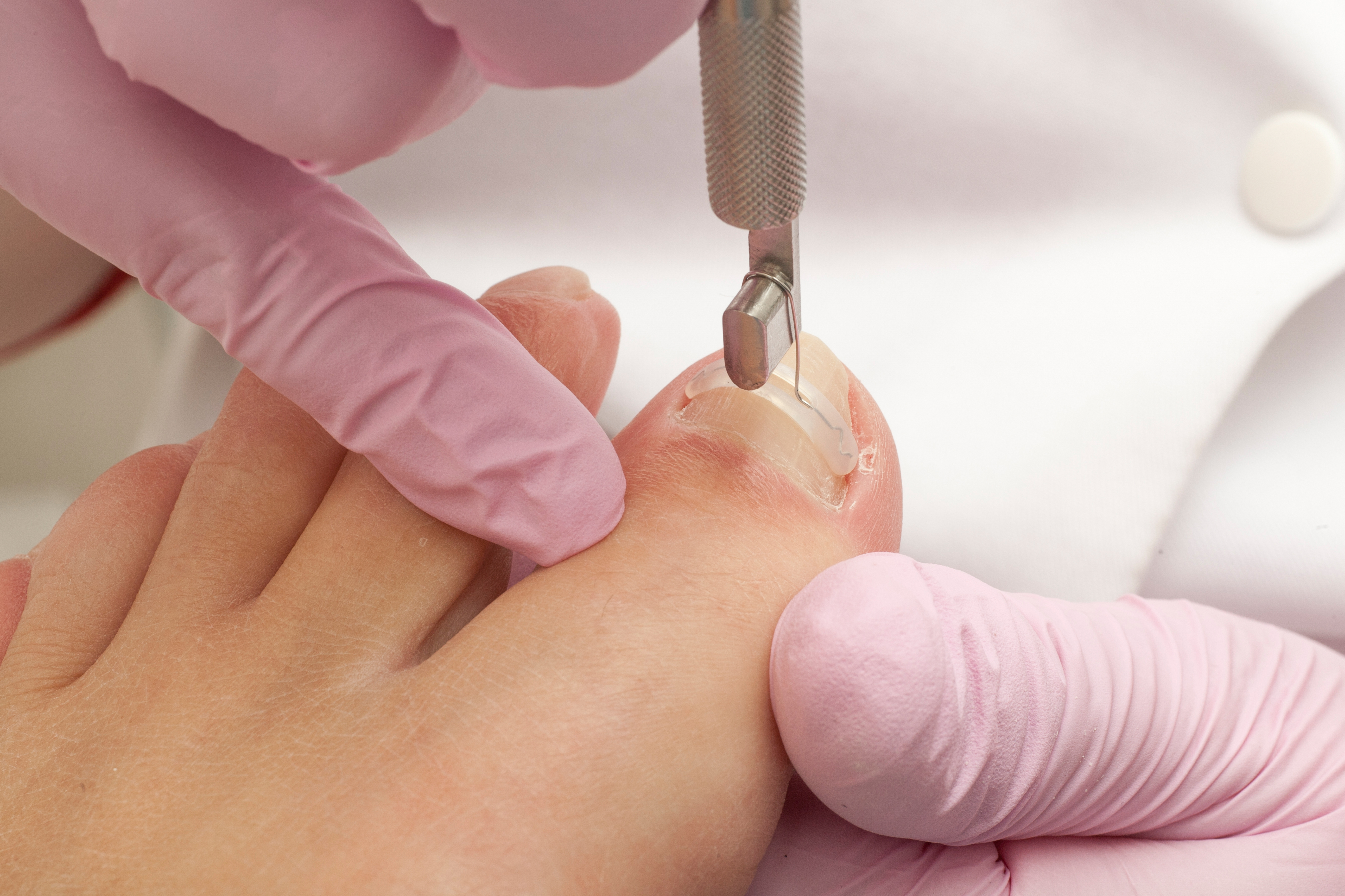 ongle cassé ou dédoublé podologie nyon