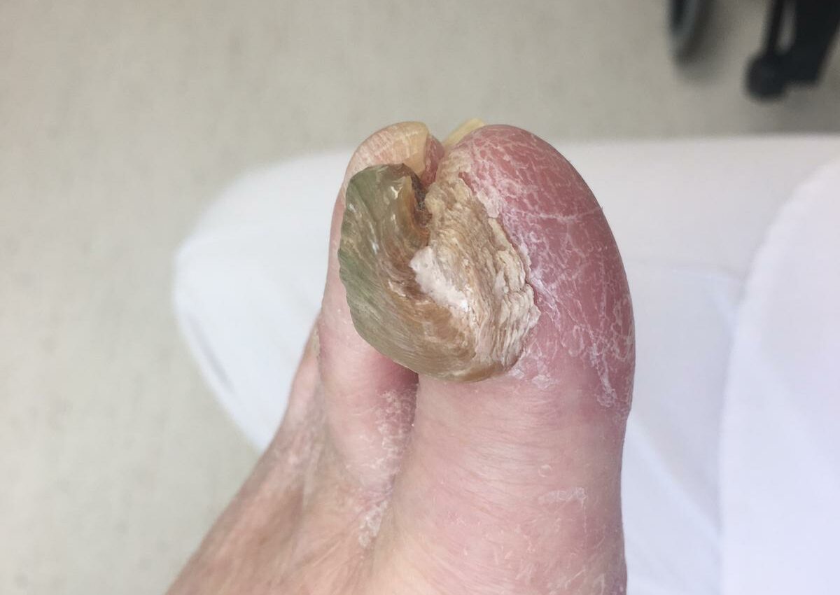 onychogryphose podologie nyon