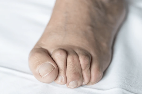 orteils en griffe orteils en marteau podologie nyon