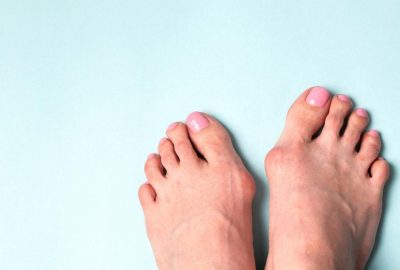 hallux valgus oignon pied podologie nyon