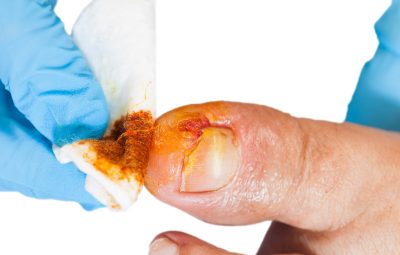 ongle incarné podologie nyon