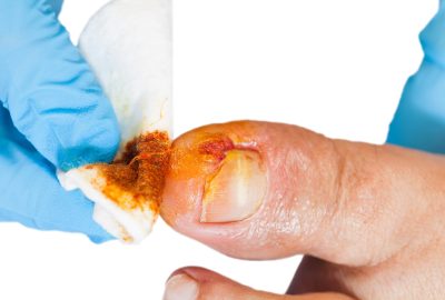 ongle incarné podologie nyon